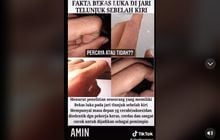 Lagi Viral Miliki Bekas Luka Di Jari Telunjuk Tangan Kiri Diklaim Mempunyai Masa Depan Cerah Benarkah Teras Gorontalo