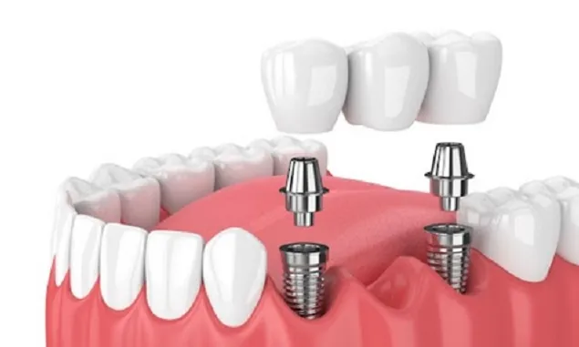 Ini Kelebihan Dental Implant, Gigi Tertanam di Tulang dan Dapat Bertahan Lama