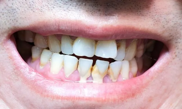 Catat! Ini Sederet Efek Karang Gigi yang Berbahaya bagi Kesehatan