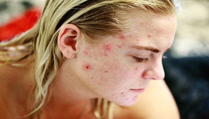 Kulit Wajah Sedang Break Out, Kandungan Skincare Ini Wajib Kamu Hindari