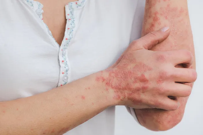 Apa Itu Psoriasis? Hati-hati, Bukan Penyakit Kulit Biasa, Ini Fakta ...