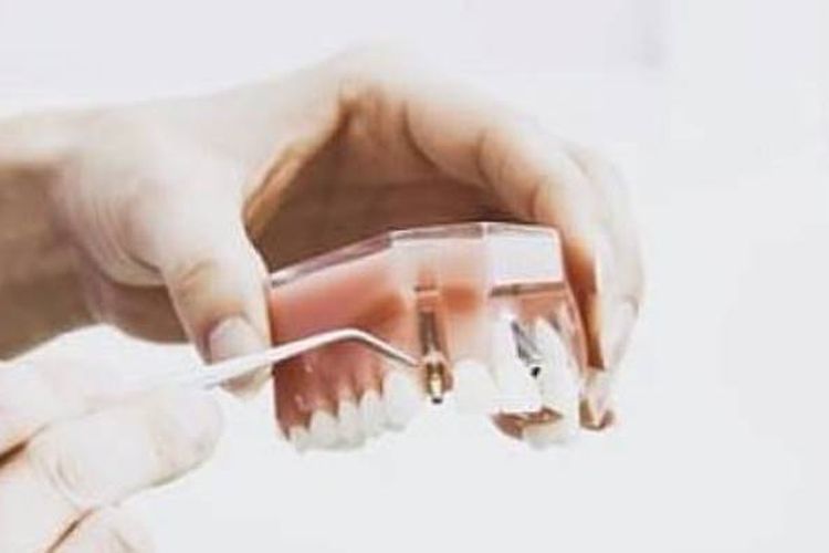 Ahli Ungkap Penyebab Masalah Pada Pengguna Gigi Palsu Salah Satunya Pola Hidup Yang Tidak Higienis Pikiran Rakyat Depok