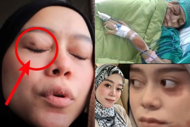 Akibat Kdrt Lesti Kejora Mendapat Luka Di Bagian Mata Rahang Dan