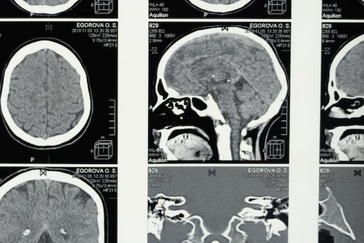 Various Medical Treatments for Cerebral Tumors, from Surgery to Immunotherapy