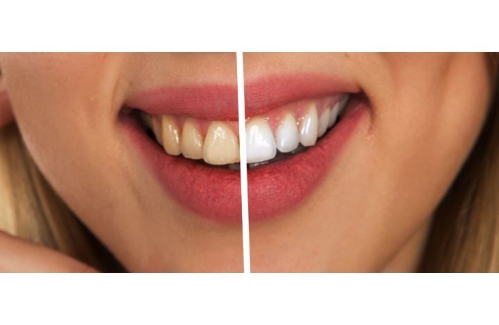 Sebelum Melakukan Whitening Atau Veneer Gigi Sebaiknya Perhatikan Ini Pikiran Rakyat Com