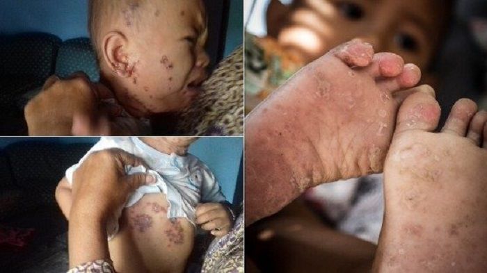 FOTO anak yang menderita penyakit kulit akibat limbah beracun di Lakardowo, Mojokerto, Jawa Timur