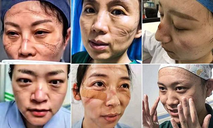 FOTO-foto staf medis yang kelelahan dan alami bekas guratan hingga luka lecet di wajah.*