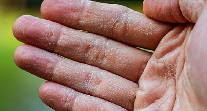 Ilustrasi dermatitis pada tangan yang mungkin terjadi akibat penggunaan hand sanitizer secara berlebihan