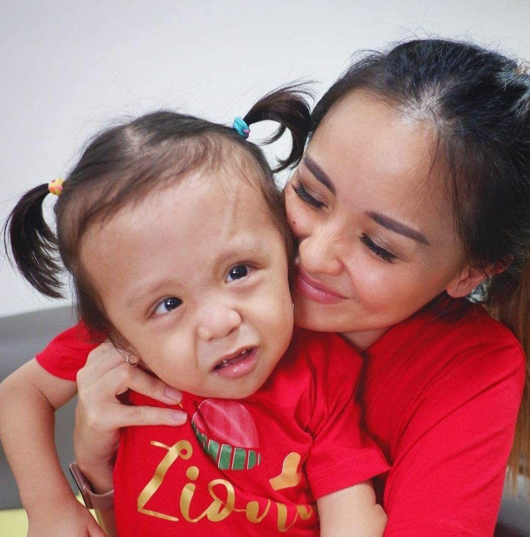 Anak Joanna Alexandra menderita Campomelic Dysplasia (CMD)