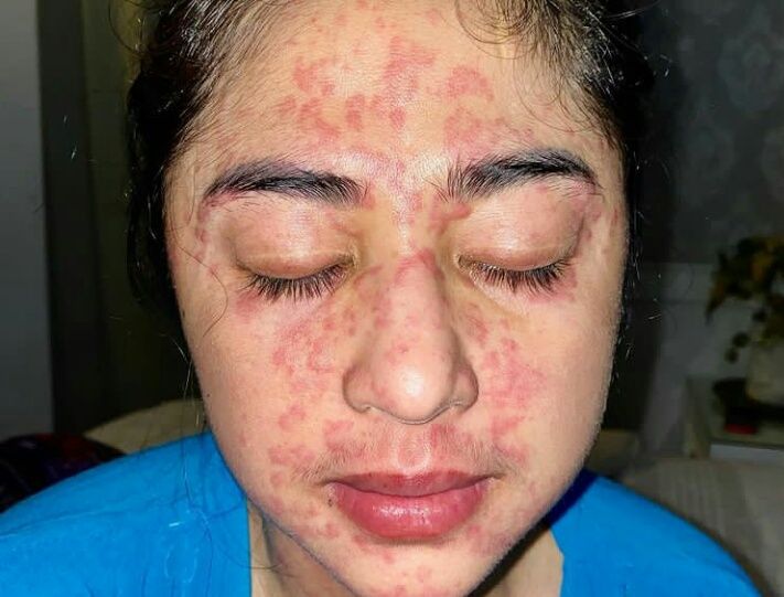 Bercak merah di muka Dewi Persik akibat virus corona