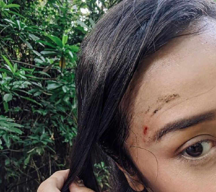 dahi anya geraldine lecet akibat jatuh dari sepeda di Bali