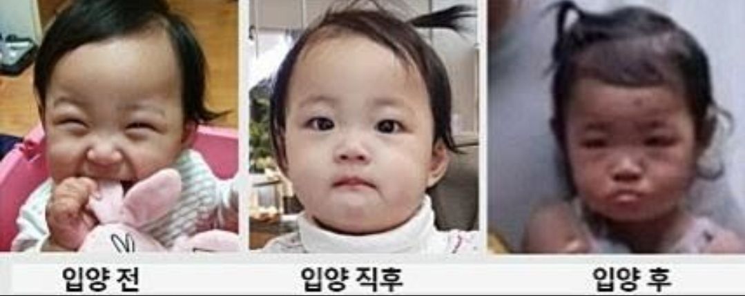 Jung In sebelum adopsi (kiri), setelah adopsi (tengah), beberapa bulan setelah adopsi (kanan)