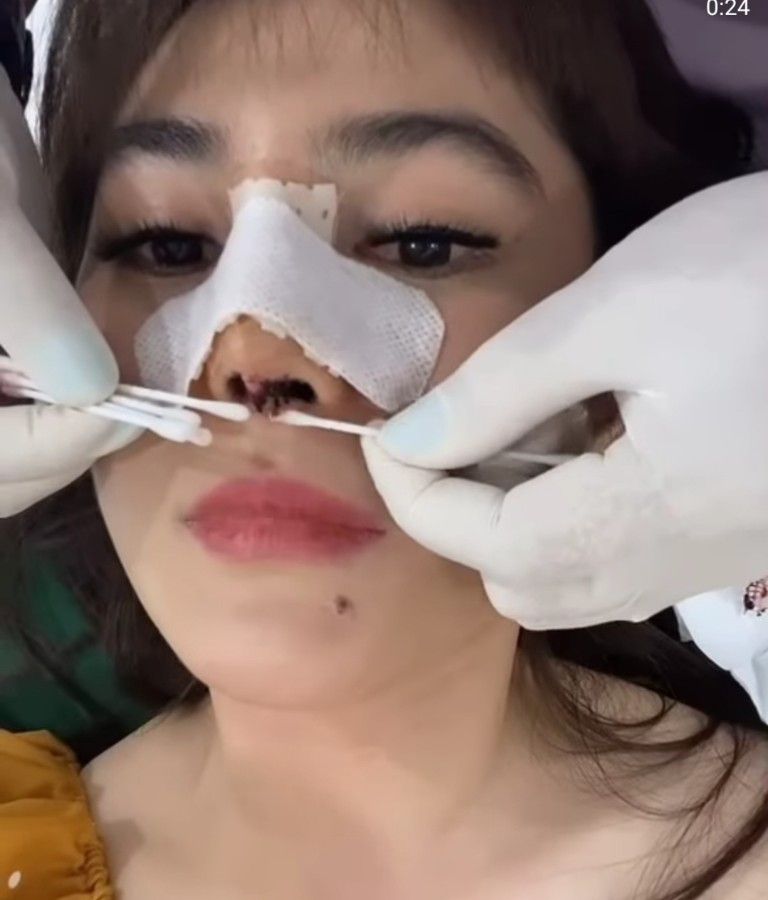 Operasi hidung Angel Lee