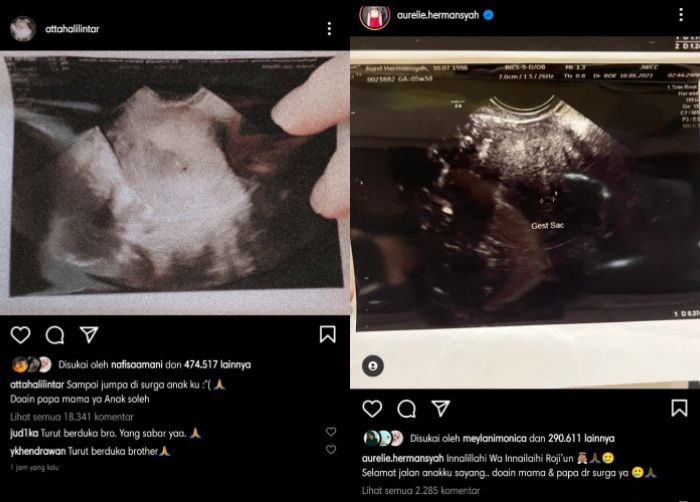 Aurel Hermansyah dan Atta Halilintar harus merelakan calon jabang bayi yang ada di perut Aurel karena kini telah tiada.