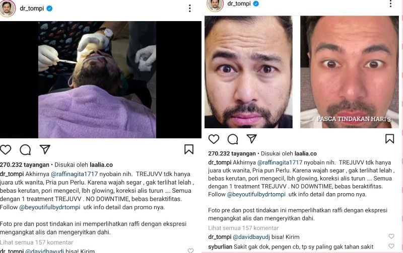 Foto before after wajah Raffi Ahmad usai disulap oleh dr. Tompi membuat ngeri netizen hingga sebut sakit atau tidak.