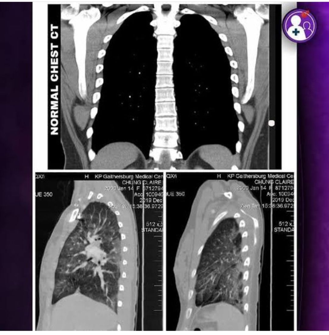 Paru-paru normal (atas) paru-paru Claire (bawah) (1).