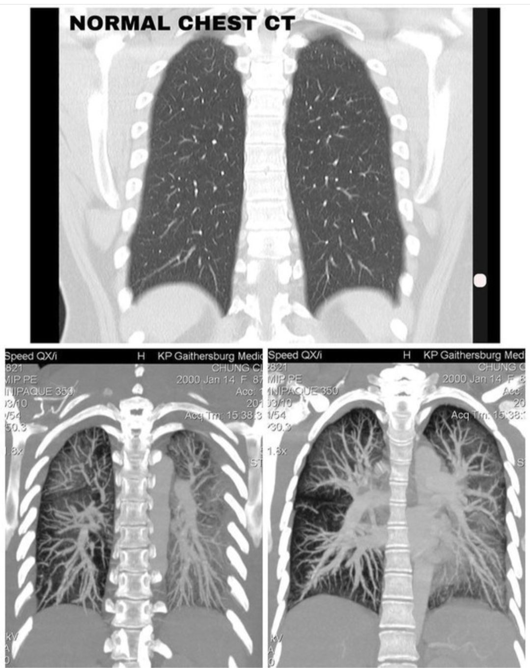Paru-paru normal (atas) paru-paru Claire (bawah) (2).