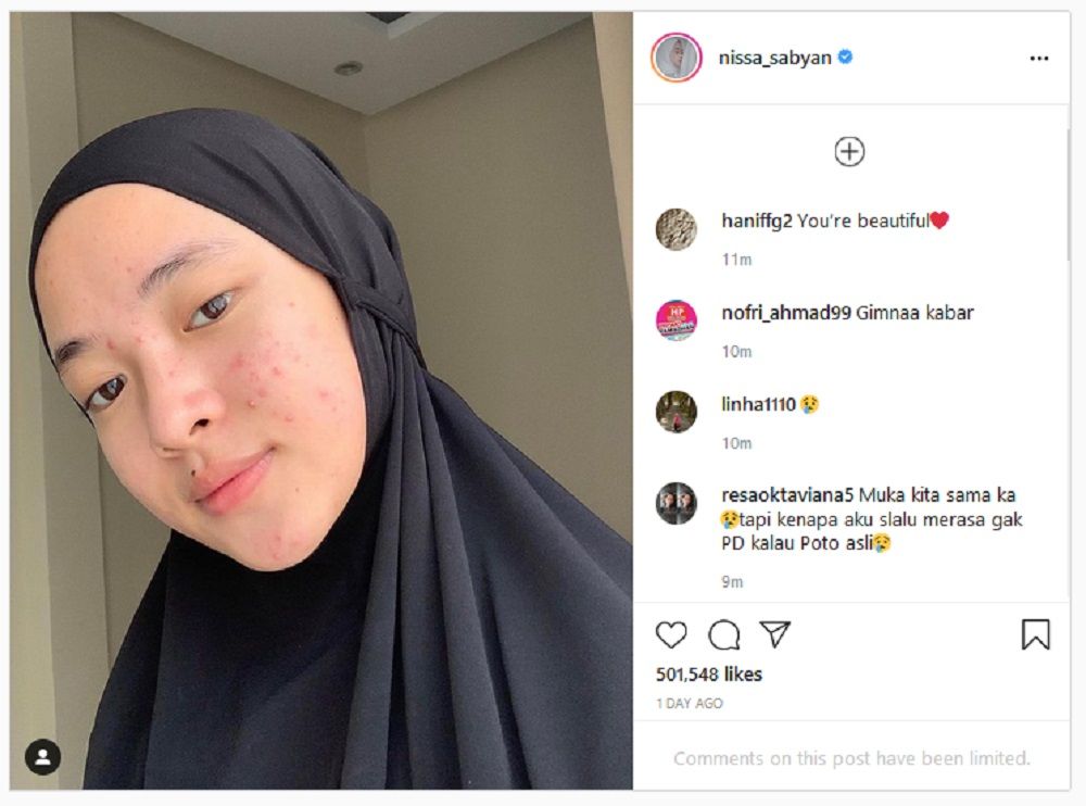 Nissa Sabyan Mendadak Pamer Wajah Berjerawat, Komentar Iis Dahlia Diserbu Netizen