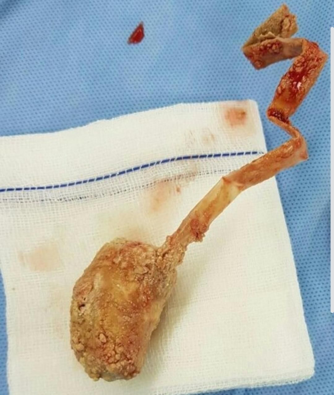 Seorang dokter menemukan sebuah potongan sedotan dari hasil operasi seorang pasien di dalam kandung kemih, peristiwa terjadi di Aceh.