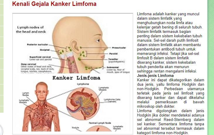 9 Gejala Kanker Limfoma yang Harus Diwaspadai. Ilustrasi Kanker Limfoma