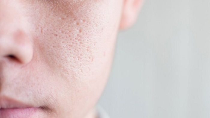 Pori-pori besar salah satu masalah kulit yang banyak dialami, dan  dengan bahan alami bisa membantu menguranginya