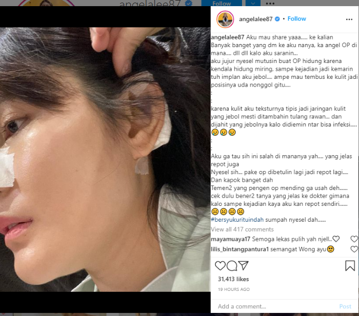   Angela Lee Mengaku Menyesal Operasi Hidung karena Alami Hal Ini dan Beri Peringatan