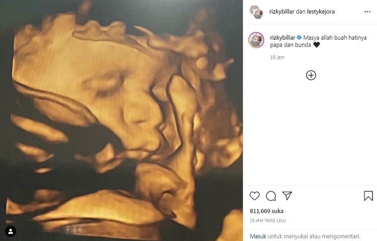 Penampakan USG bayi Rizky Billar dan Lesti Kejora