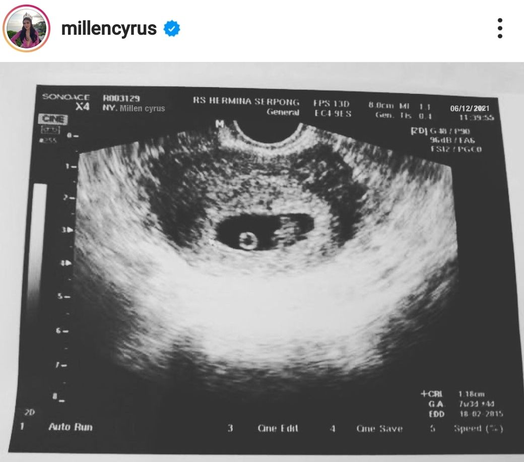 Millen Cyrus Unggah Foto USG di Instagram