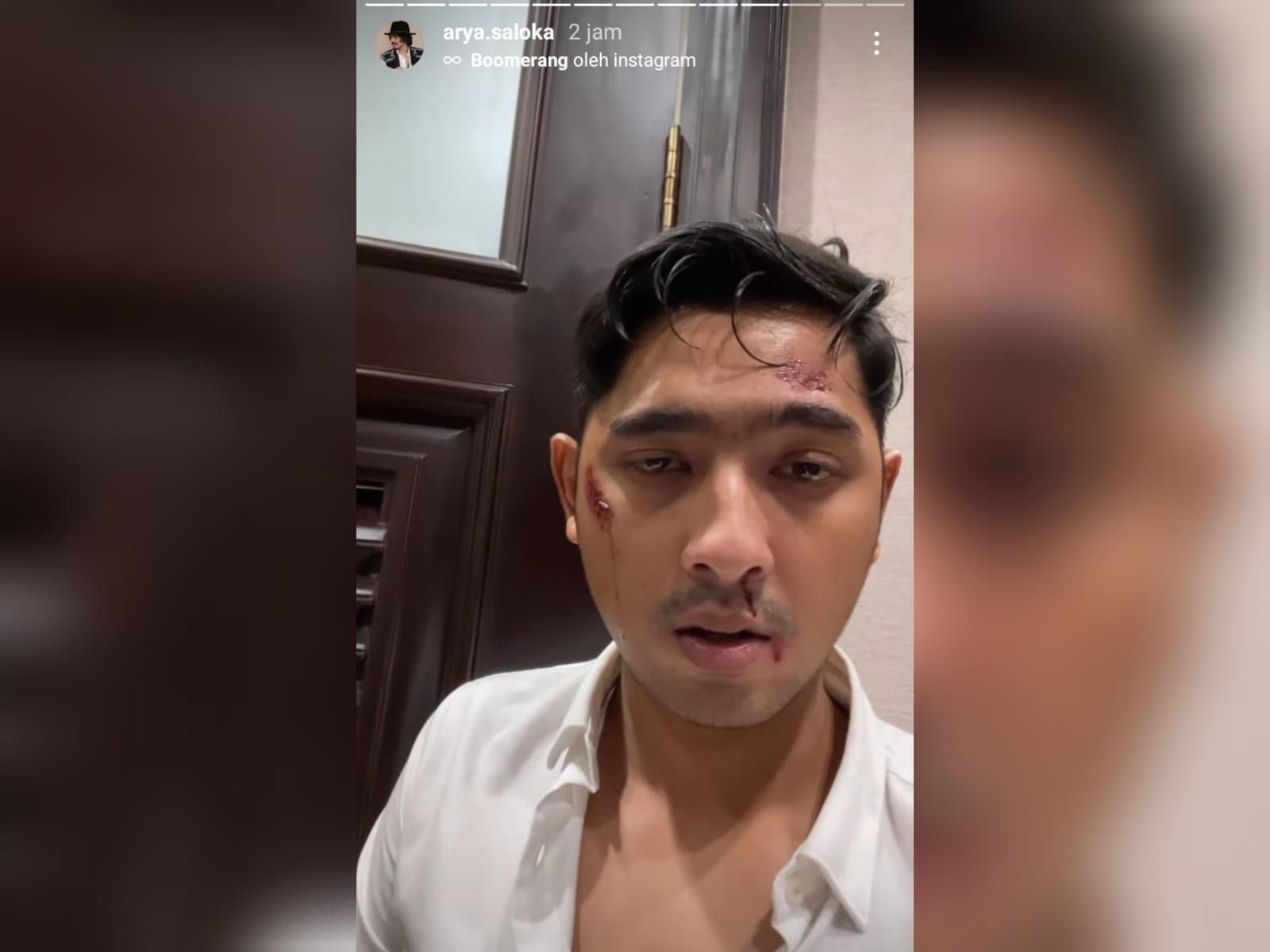 Unggahan video Arya Saloka di Instagram story miliknya terlihat wajahnya penuh luka