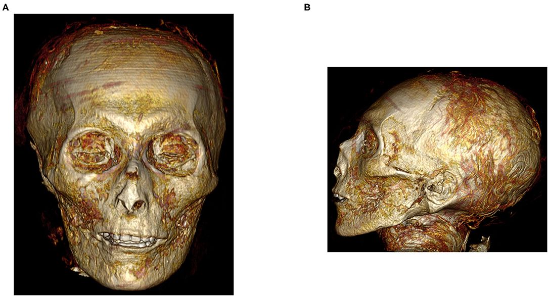 Bentuk tengkrok Firaun saat dipindai dengan CT scan menununjukan bentuk giginya yang rapi. /Frontiersin
