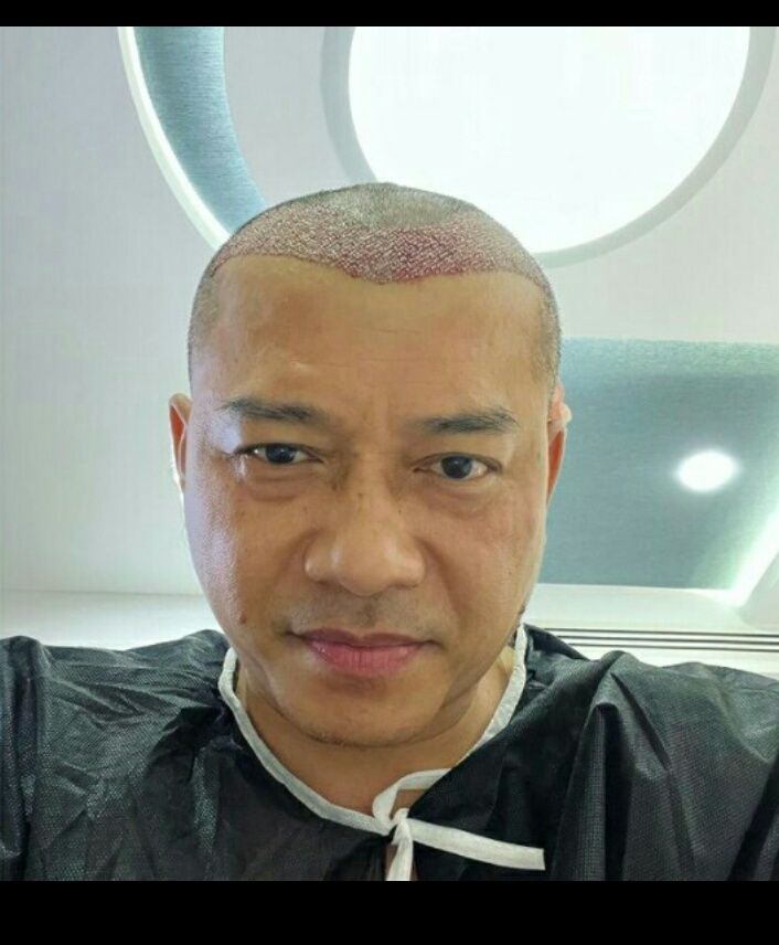 Foto: Prosedur Transplantasi Rambut yang akhir-akhir ini dilakukan Anang Hermansyah untuk mengatasi kebotakan/Instagram ananghijau