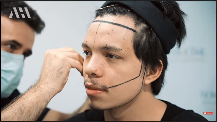 YouTuber Atta Halilintar saat tanam rambut / Atta Halilintar Transplantasi Rambut, Berapa Biayanya di Indonesia? 