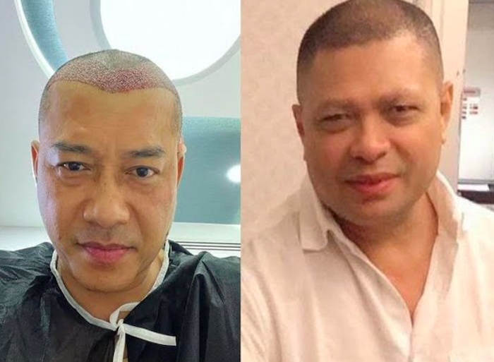 Anang Transplantasi Rambut Disebut Mirip Raul Lemos, Ashanty: Hasilnya Keceh