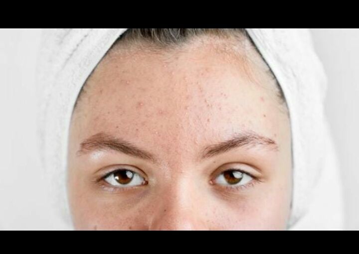 5 tips mengatasi bruntusan di wajah dengan ampuh menurut dr. Rizki Aminia/ Freepik