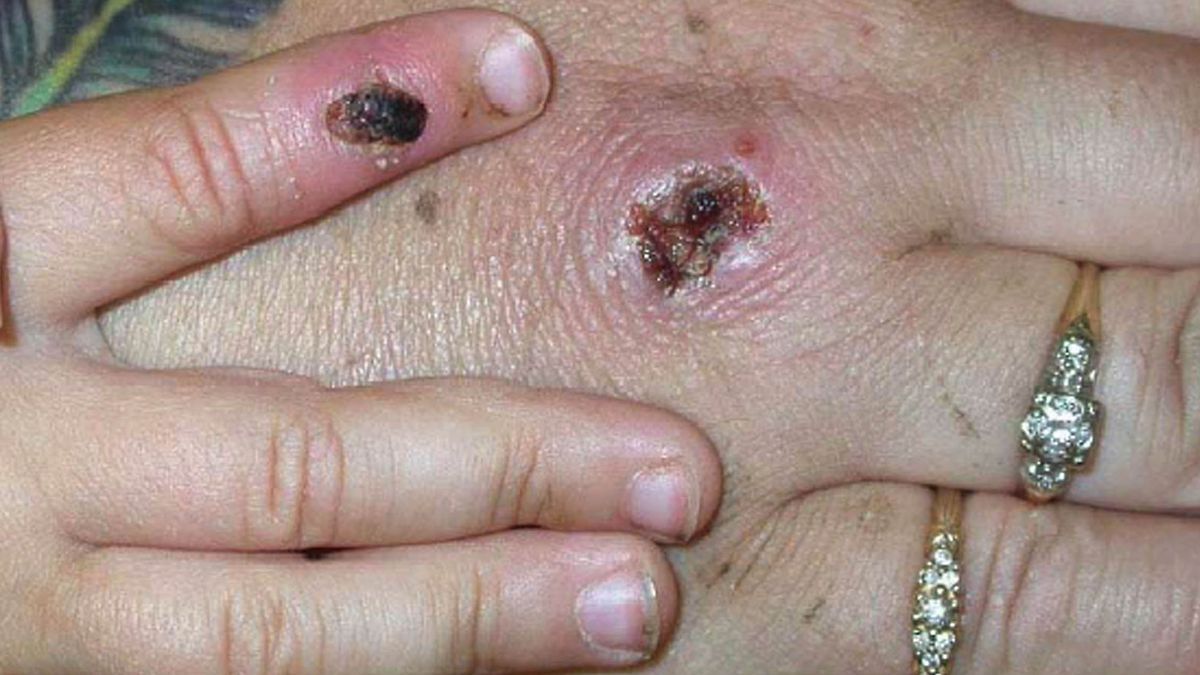 Gejala salah satu kasus pertama yang diketahui dari virus monkeypox ditunjukkan di tangan pasien.  