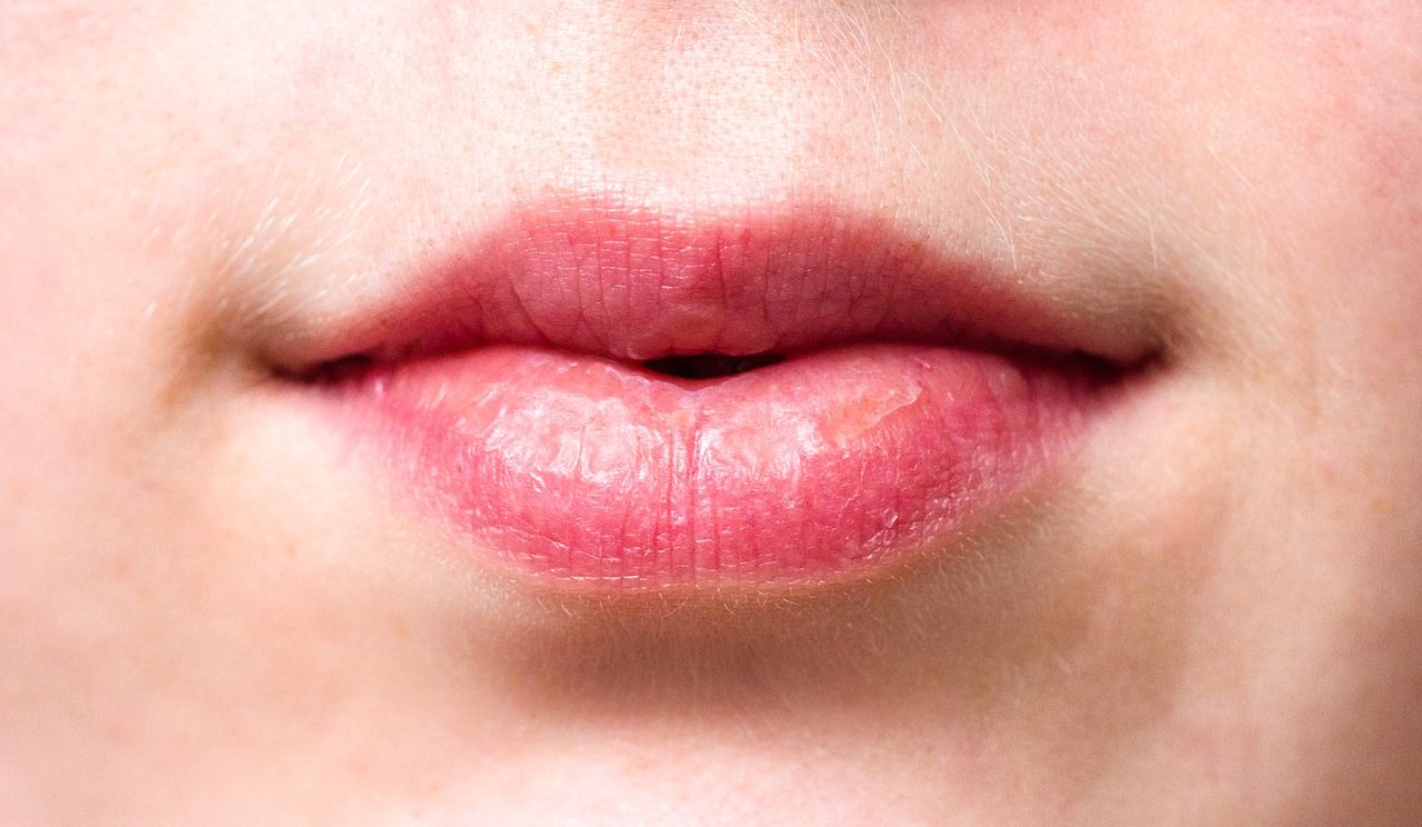 Ilustrasi bibir kering dan pecah.