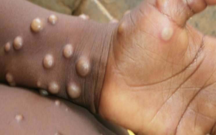 Salah satu contoh bentuk penyakit Cacar Monyet atau monkeypox yang saat ini kembali terjadi di Jawa Tengah