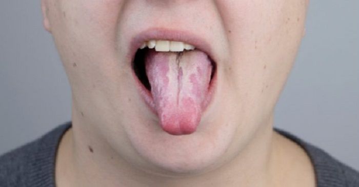 Plak putih di lidah