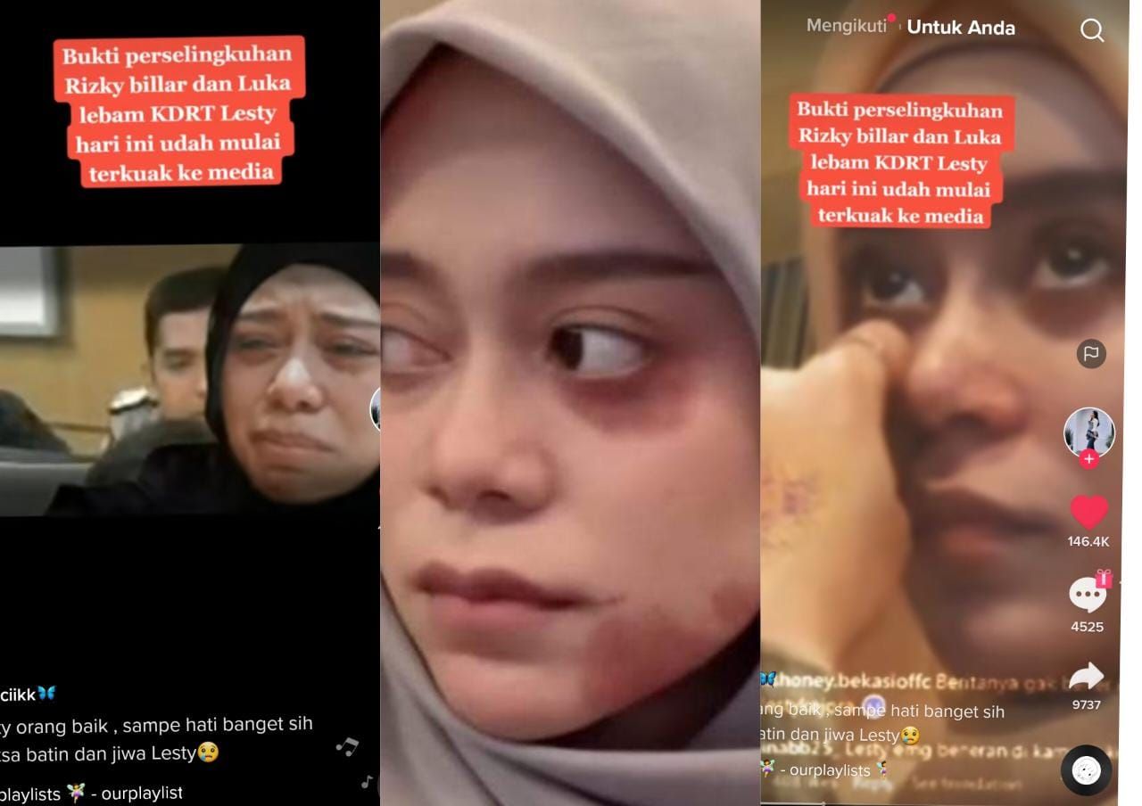 Benarkah Tangan Lesti Kejora Patah Akibat KDRT Oleh Rizky Billar? Dede