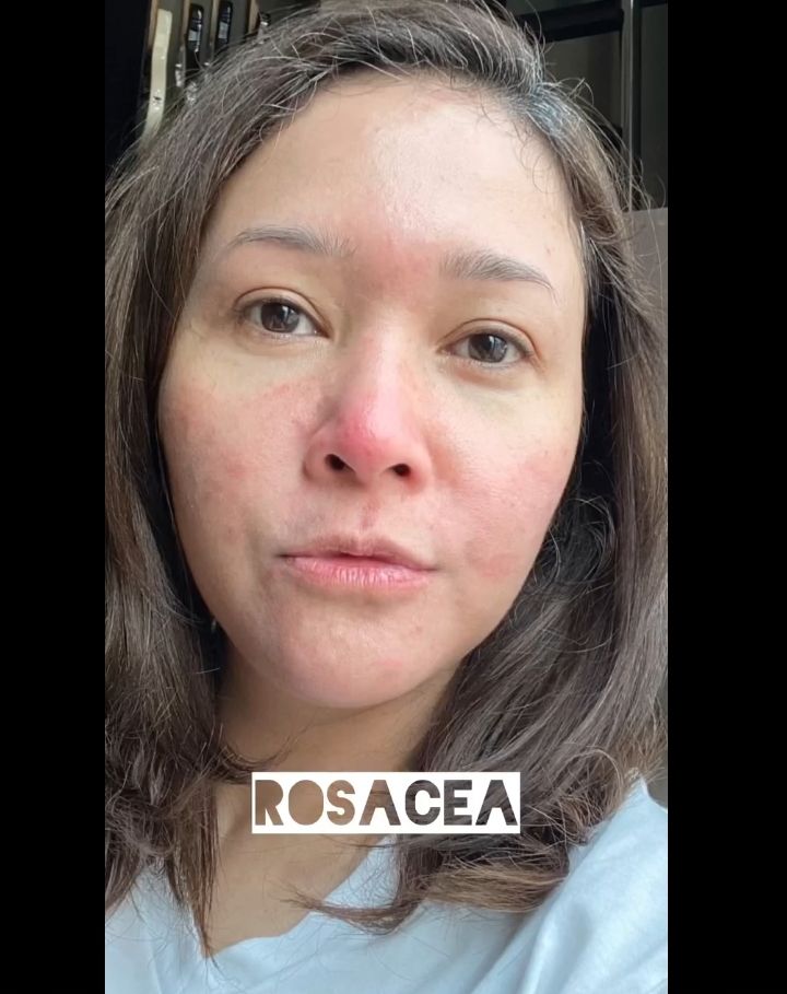Maia Estianty Idap Rosacea, Wajah Merah Bruntusan Tak Bisa Sembuh Seumur Hidup: Dari Umur 28 Tahun Pake Skincare