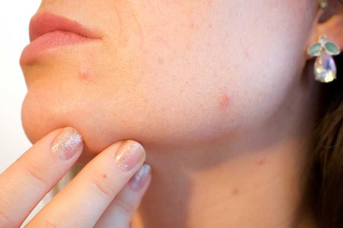 7 kebiasaan yang menyebabkan jerawat pada wajah sulit hilang menurut dr. Ema Surya Pertiwi.