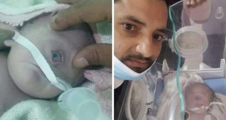 Potret bayi bermata satu yang lahir di Yaman.