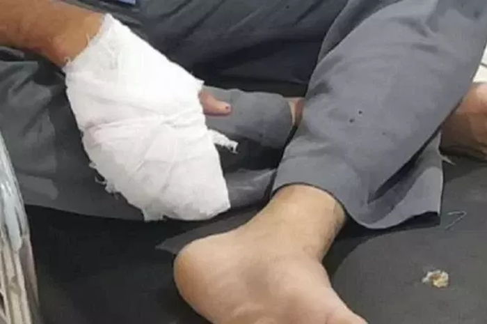 Kondisi tangan korban MA (17) pelajar dari salah satu SMK Swasta di Kecamatan Cicurug, Kabupaten Sukabumi, Jabar mengalami luka bacokan senjata tajam.