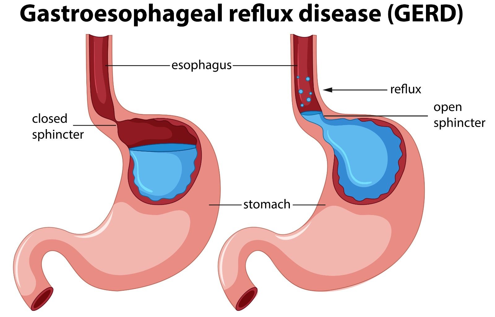 What Does Gastro Pain Feel Like