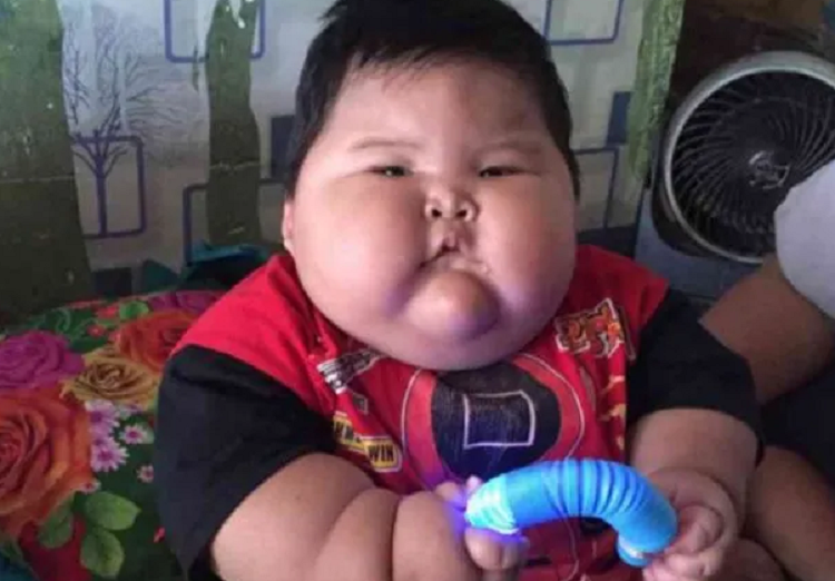 Kenzi balita asal Bekasi yang mengalami obesitas.
