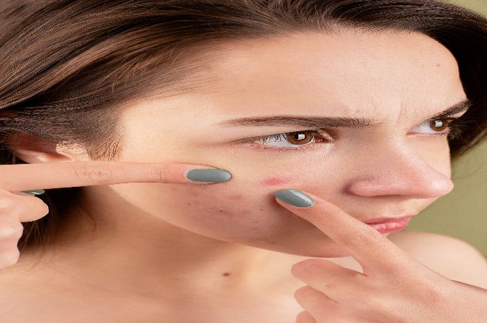 Ilustrasi pengertian Rosacea yang ditandai kemerahan pada kulit sering terjadi pada wanita tapi bukan jerawat lengkap gejala dan pengobatan.