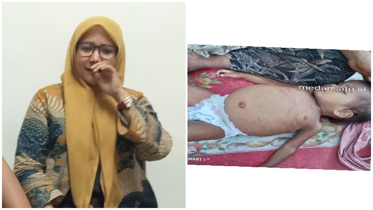 Kolase foto Kabid Pelayanan RSUD Rantauprapat, Ferdiana Kasanova dan Anak Penderita Gizi Buruk.