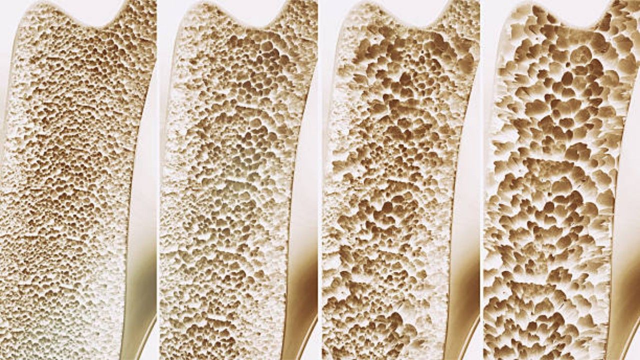 Osteoporosis vs Tulang Super