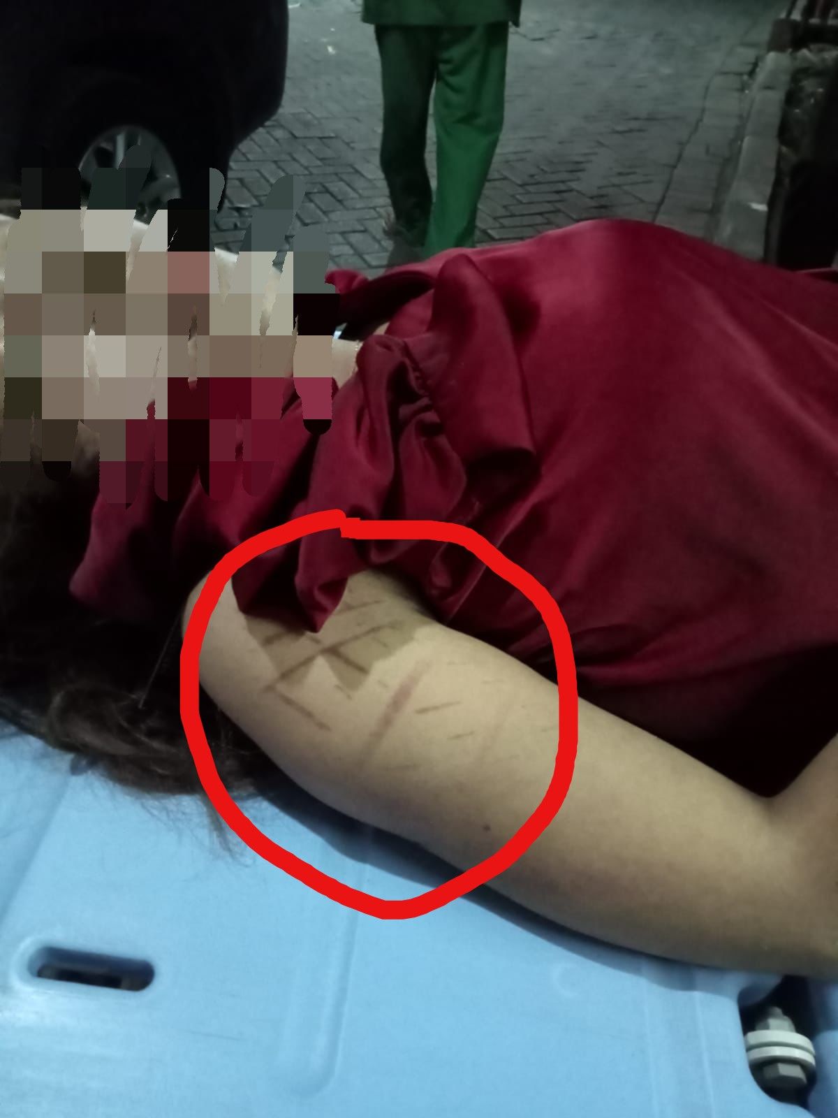 Foto diduga seleb TikTok wanita Andien berada di atas tandu, terlihat bekas seperti jejak ban di lengan kanan korban