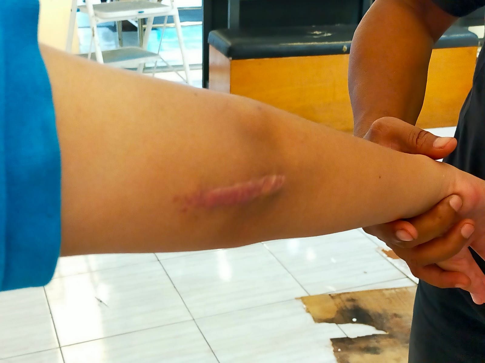 Tangan korban bullying di SD Sukabumi usai dioperasi patah tulang. 